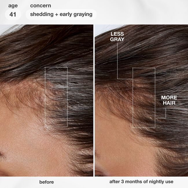 Before-and-after comparison of a person's scalp showing hair shedding reduction. The left panel is labeled 'before' and shows visible hair loss at the crown; the right panel is labeled 'after 3 months of nightly use' and shows denser hair.